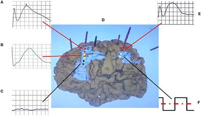 Cortico-Cortical Evoked Potentials in Children With Tuberous Sclerosis Complex Using Stereo-Electroencephalography